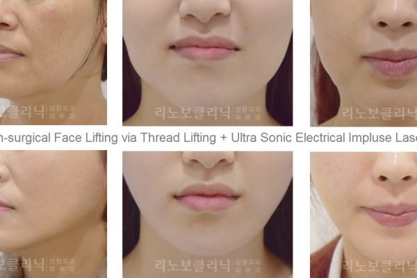 19 skin care before and after non surgical face lift seoul guide medical