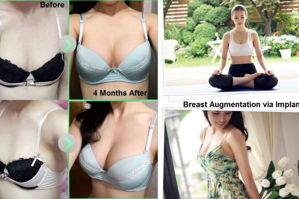 14 breast augmentation via implants and lift before and after seoul guide medical