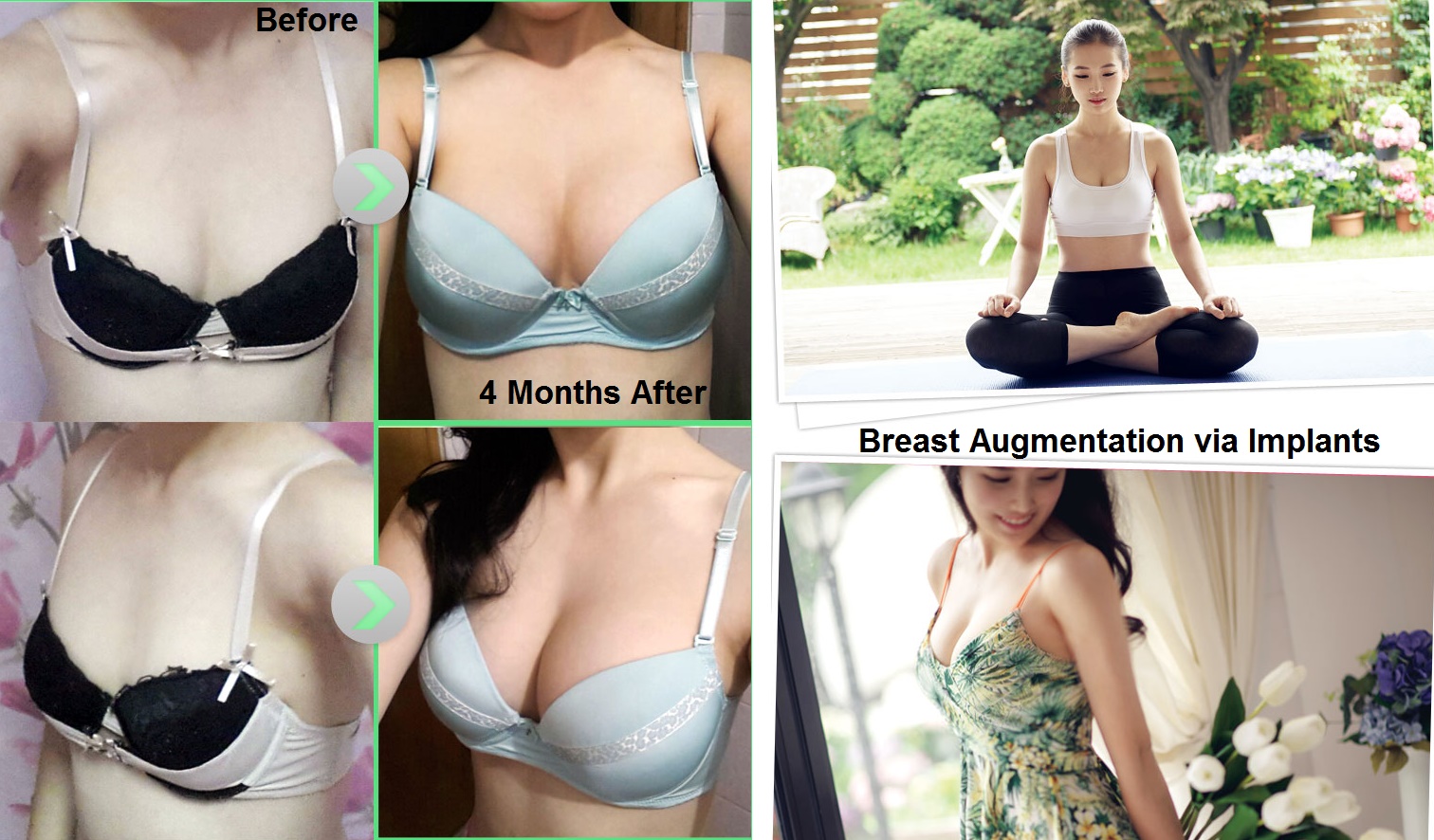 2Benefits. of each Breast Augmentation Incision Type. 