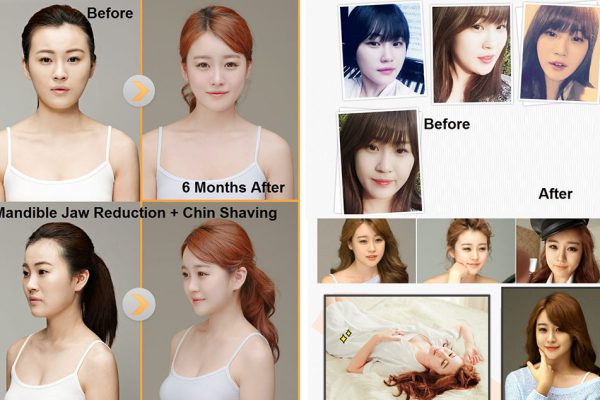 23 face contouring seoul guide medical before and after mandible reduction and chin shaving
