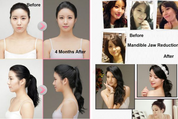 24 face contouring seoul guide medical before and after mandible reduction