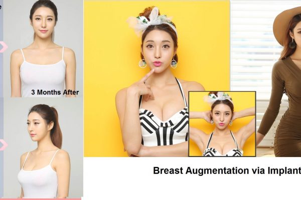 7 breast implants before and after seoul guide medical