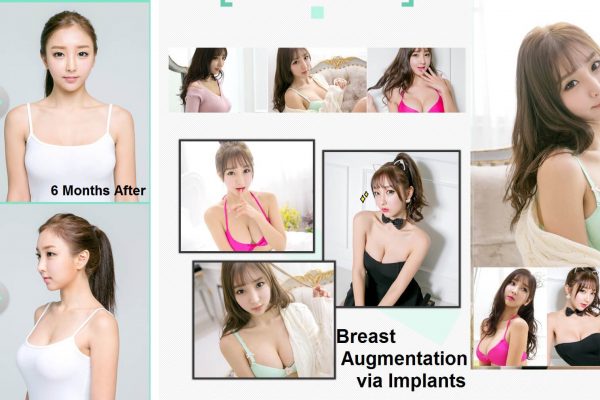 8 breast implants before and after seoul guide medical