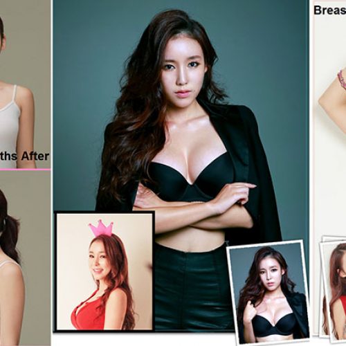 breast augmentation and implants in seoul, korea at dodream plastic surgery