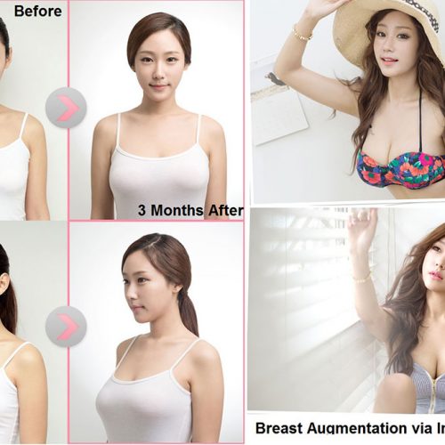 Natural breast augmentation with seoul guide medical and dodream plastic surgery