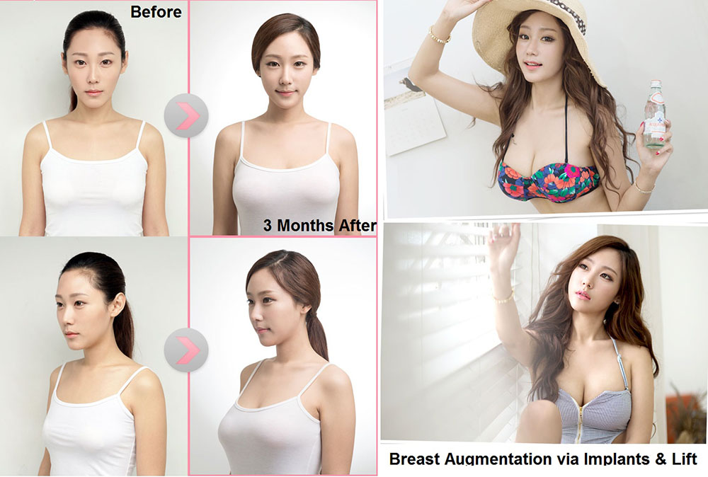Natural breast augmentation with seoul guide medical and dodream plastic surgery