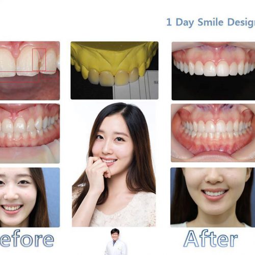 dental veneers at oaks dental clinic through seoul guide medical