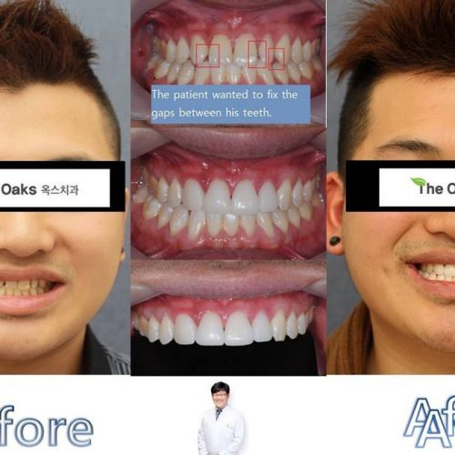 dental veneers at oaks dental clinic with seoul guide medical in korea
