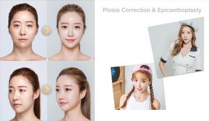 ptosis correction and epicanthoplasty in korea with seoul guide medical