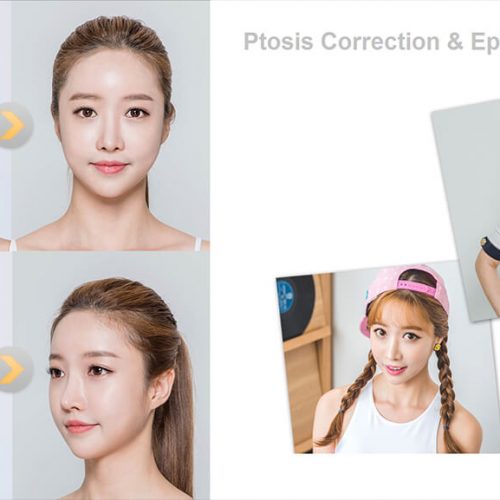 ptosis correction and epicanthoplasty in korea with seoul guide medical