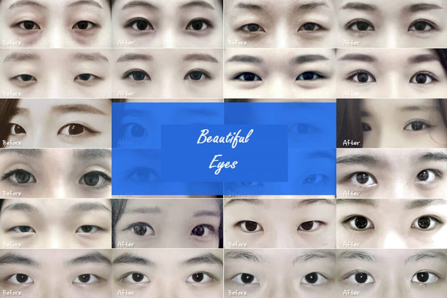 Double Eyelid Surgery in Korea Seoul Guide Medical