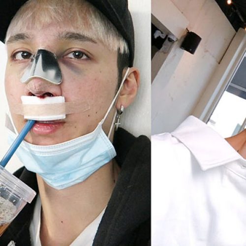 Edward Avila rhinoplasty and filler seoul guide medical