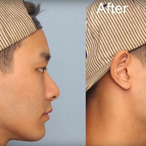 Haeppy We Fancy non-surgical rhinoplasty at seoul guide medical