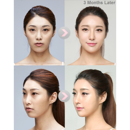before and after plastic surgery in korea seoul guide medical