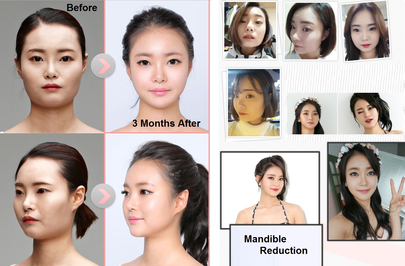Plastic Surgery Before and after Archives Seoul Guide