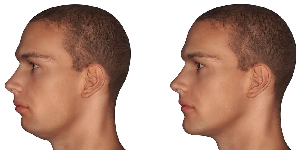 Jaw Surgery for mens