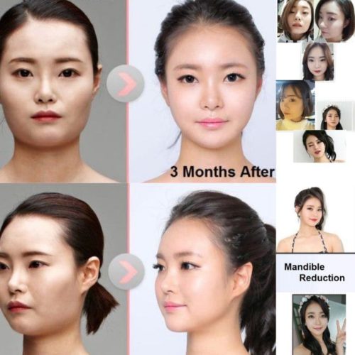 laser eye surgery korea