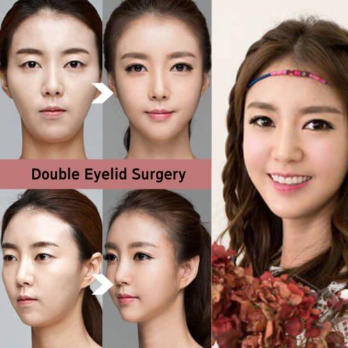 double eyelid surgery in korea