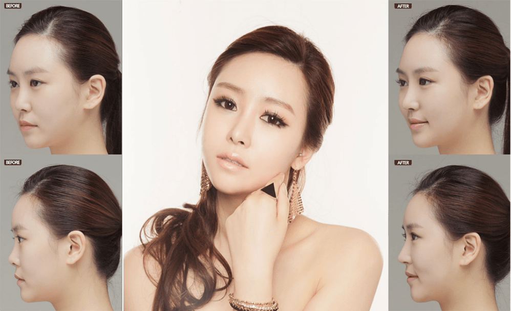 Nose Plastic Surgery In Korea - Everything About Rhinoplasty - Seoul Guide  Medical