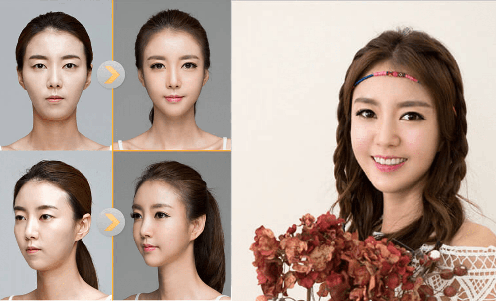 best eyelid surgery in korea