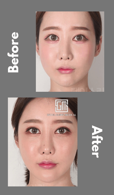 Revision double eyelid surgery also known as Blepharoplasty correction or e...