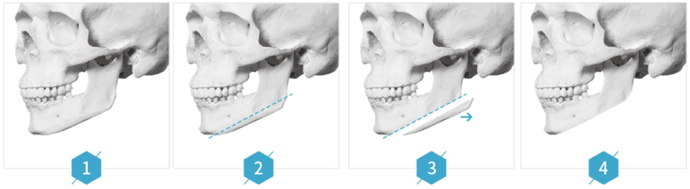 Facial Contouring Surgery Korea: 3D Cheekbone, Face Sculpting - The Line  Clinic