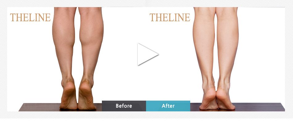 calf reduction surgery before and after