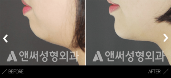chin augmentation in korea before and after