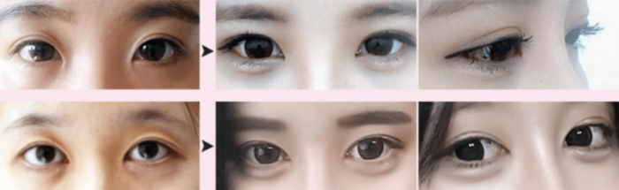 Revision Double Eyelid Surgery - Everything You Need to Know - Seoul Guide  Medical