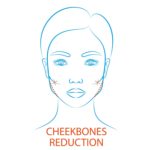 cheekbone reduction surgery 