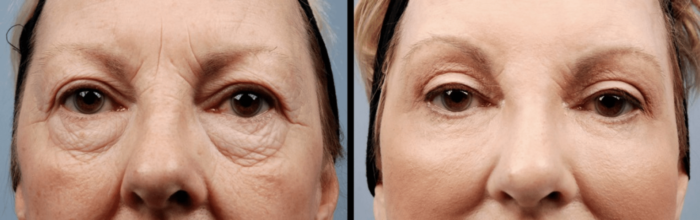 Under Eye Fat Grafting - Quick facts before getting Under Eye Fat ...