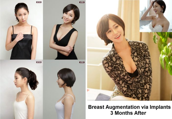 breast augmentation via implants before and after 3 months