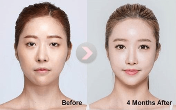 How to get a square jawline quickly? – JawDesign