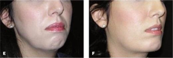jaw implants before and after