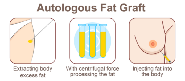 fat grafting alternative method of breast augmentation