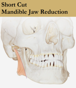 Square Jaw Reduction: Procedure Steps, Recovery Time, Costs, and Much More  - Seoul Guide Medical