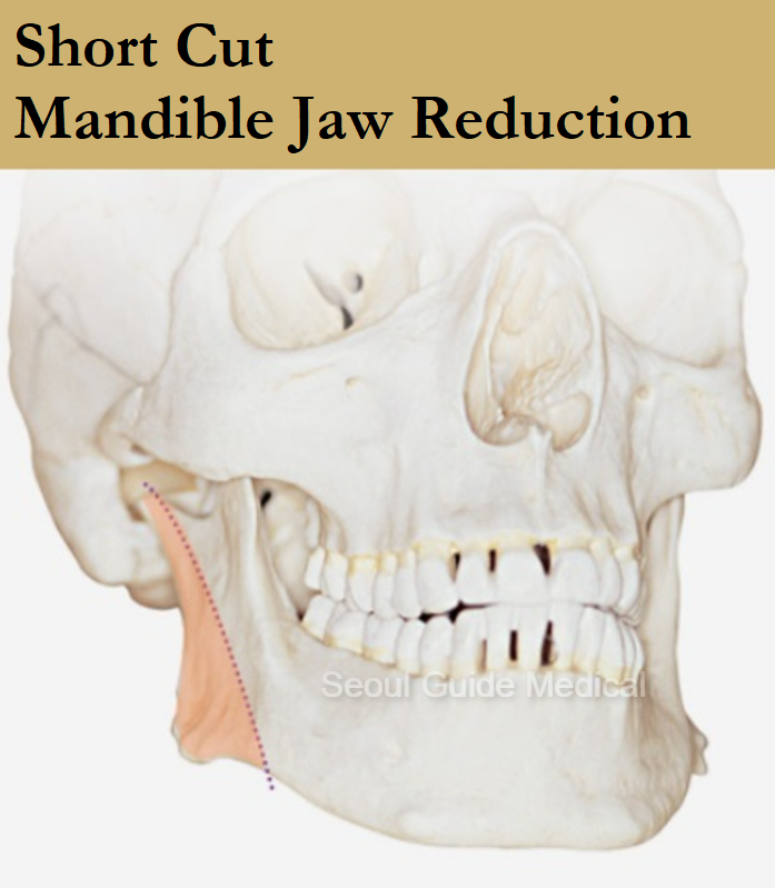 Square Jaw Reduction Procedure Steps, Recovery Time, Costs, and Much More Seoul Guide Medical