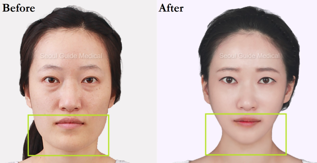 Square Jaw Reduction: Procedure Steps, Recovery Time, Costs, and Much More  - Seoul Guide Medical