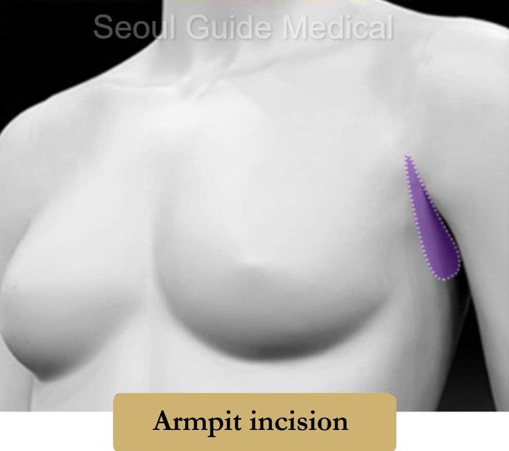 Teardrop Breast Surgery, Teardrop Breast Prosthesis in Seoul