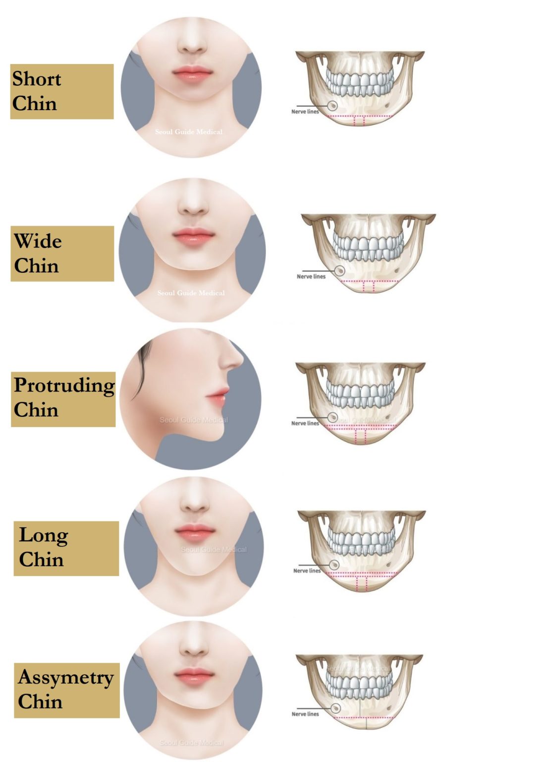 Genioplasty: Your Guide To Chin Surgery In South Korea - Seoul Guide ...