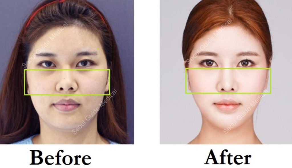 Cheekbone Reduction