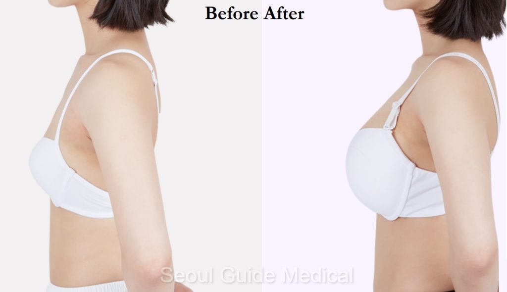 Self-Adhesive Silicone Breast Models - Teardrop Breast Implants