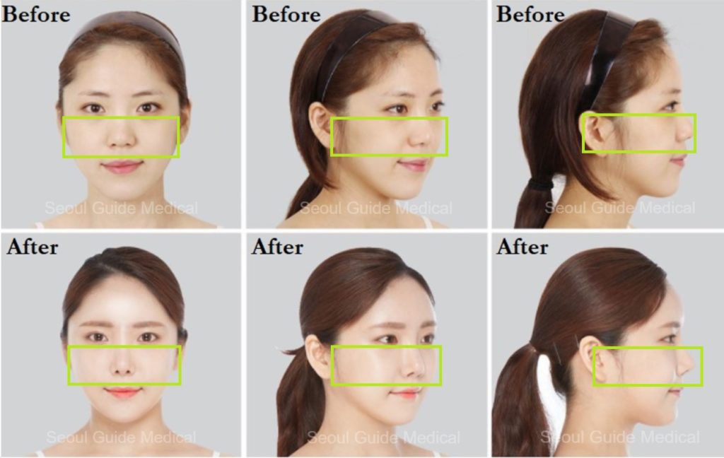 Cheekbone Reduction