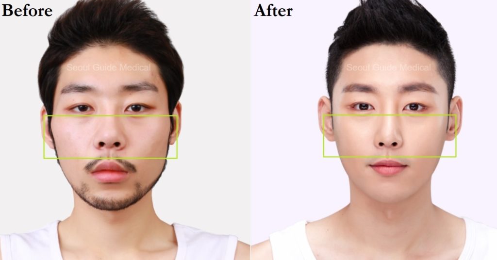 Cheekbone Reduction