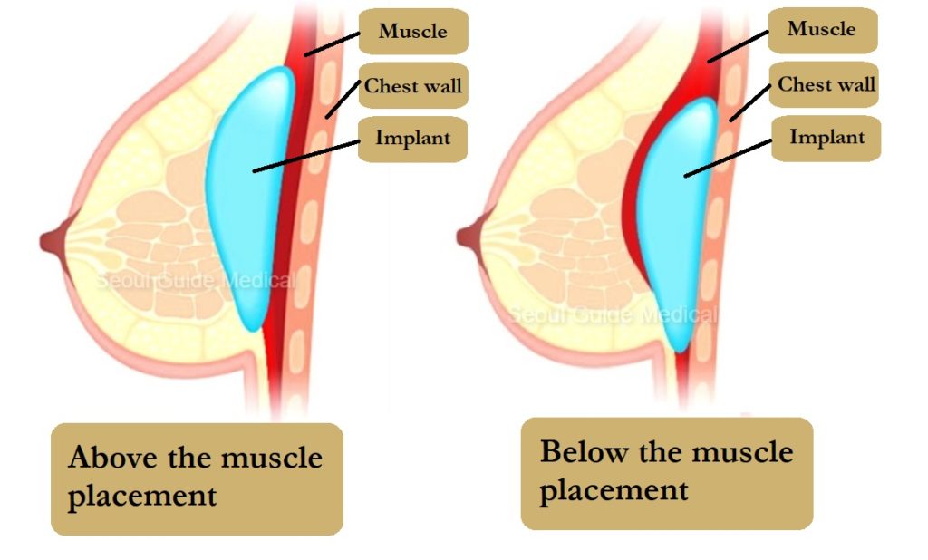 Breast Implant Placement: Under-the-muscle vs. over-the-muscle
