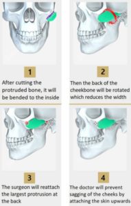 Your Guide to Getting Zygoma Reduction in Korea - Seoul Guide Medical