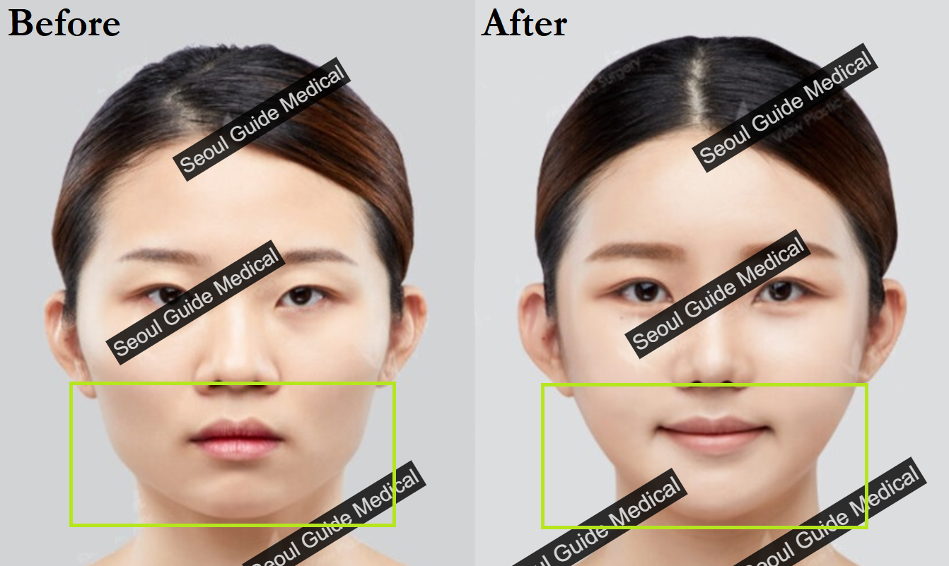 Square Jaw Reduction: Procedure Steps, Recovery Time, Costs, and Much ...