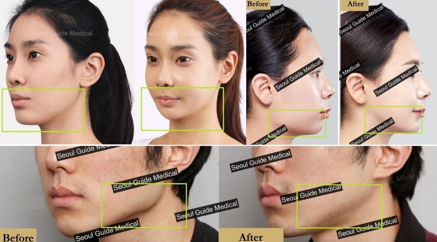 Square Jaw Reduction: Procedure Steps, Recovery Time, Costs, and Much More  - Seoul Guide Medical
