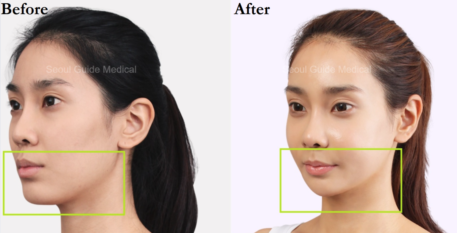 Square Jaw Reduction: Procedure Steps, Recovery Time, Costs, and Much ...