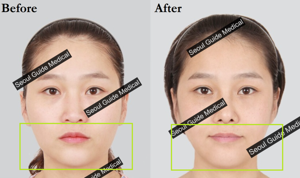 Square Jaw Reduction: Procedure Steps, Recovery Time, Costs, and Much ...